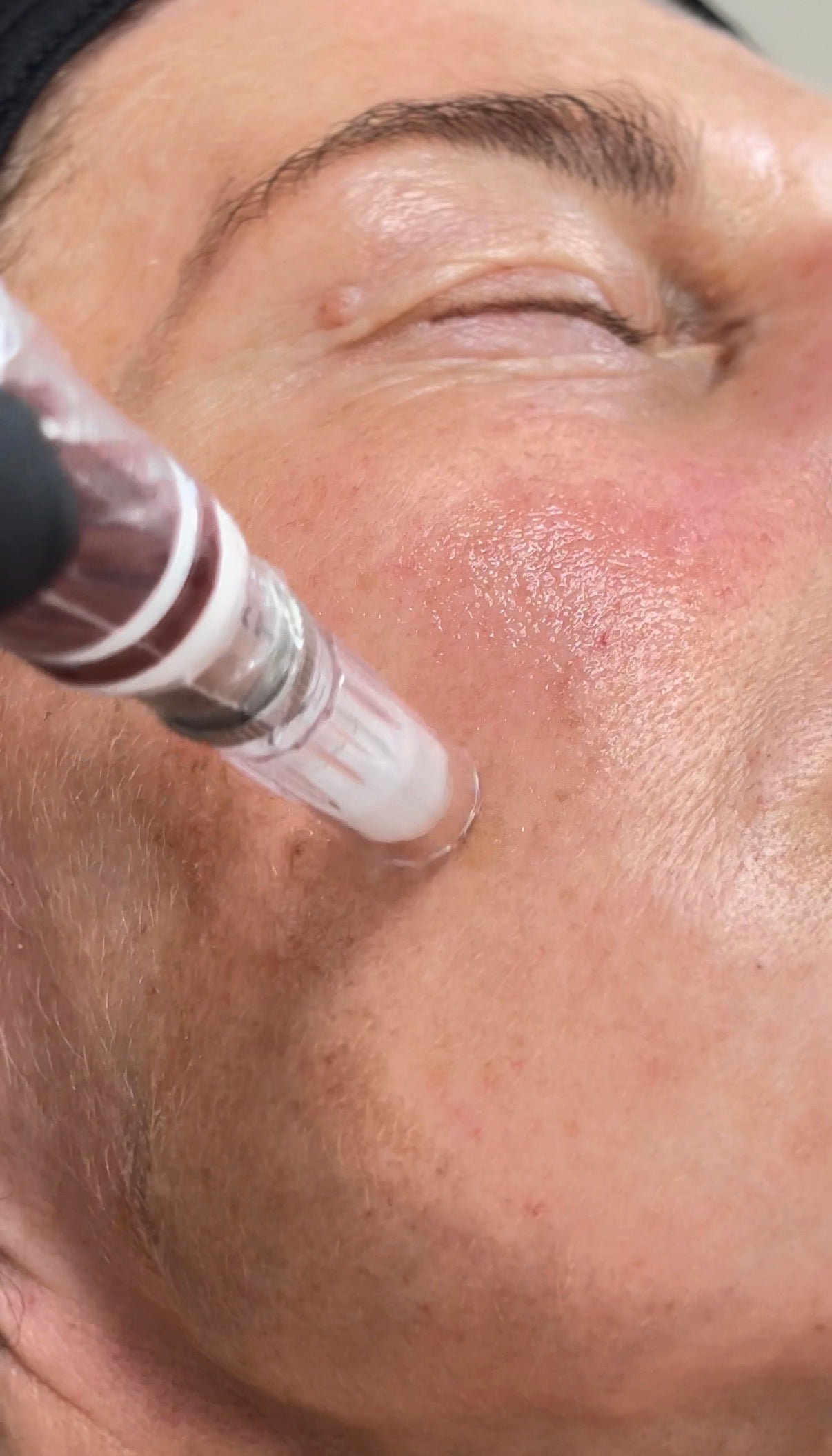 Microneedling with Exosomes